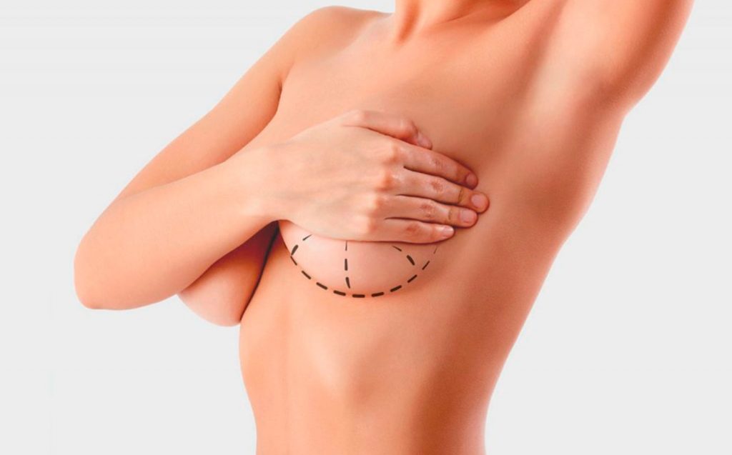 Cosas que debes saber si estás pensando en realizarte una mamoplastia