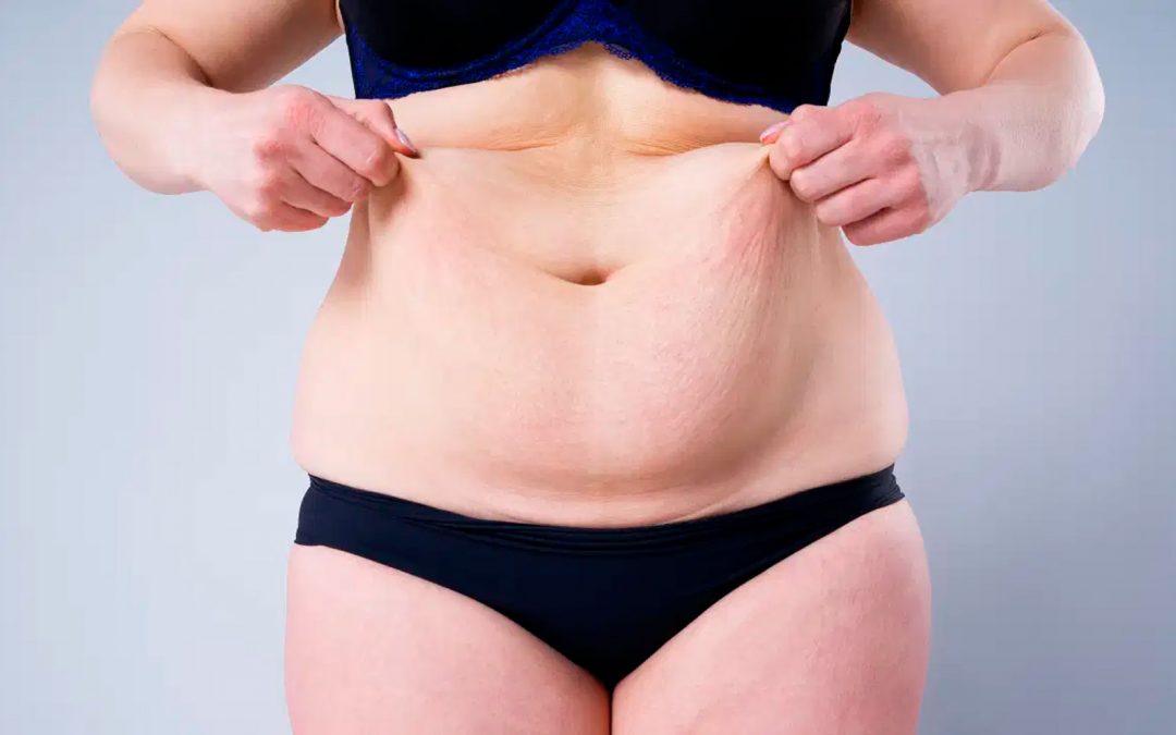 Transformación corporal estética tras la pérdida de peso