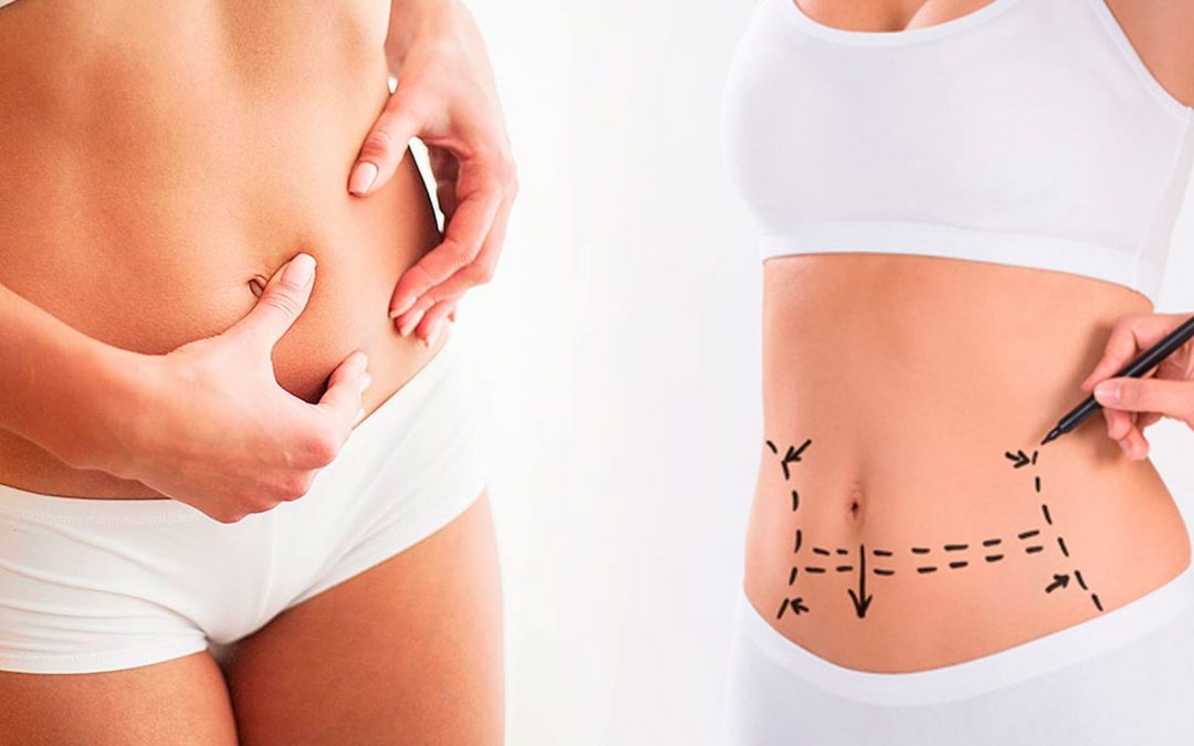 Diferencia entre la abdominoplastia y la liposucción